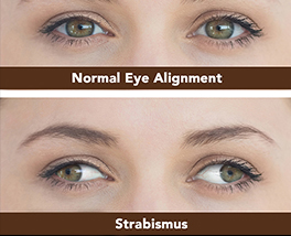Adult Strabismus Surgery